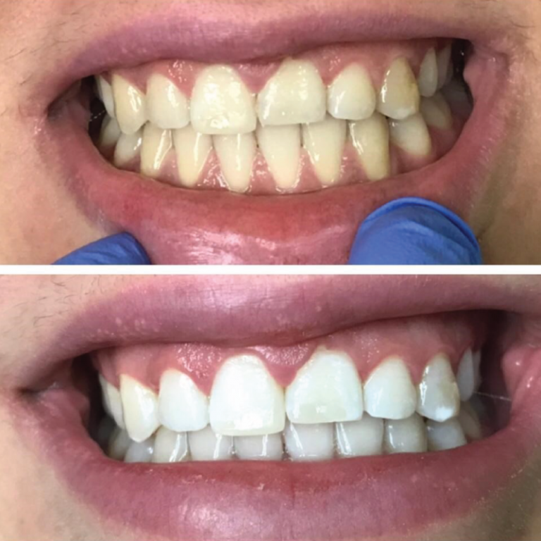 Teeth Whitening Sudbury | Sudbury Dental Clinic