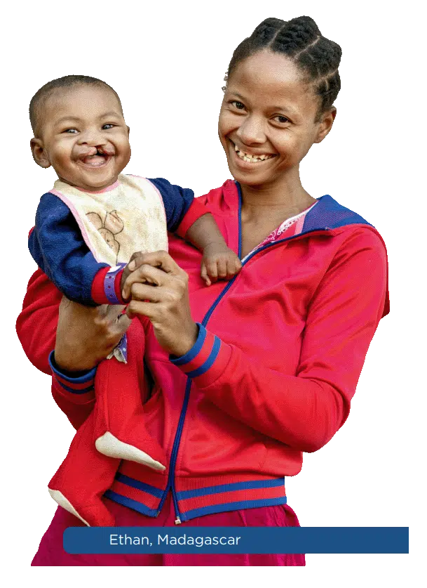 A mother and her child — Operation Smile